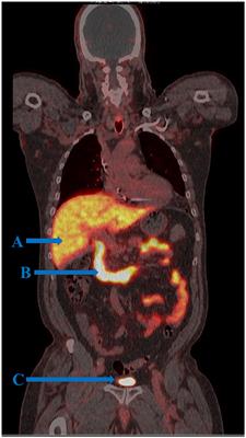 Gender and disease-inclusive nomenclature consolidation of theragnostic target, prostate-specific membrane antigen (PSMA) to folate hydrolase-1 (FOLH1)